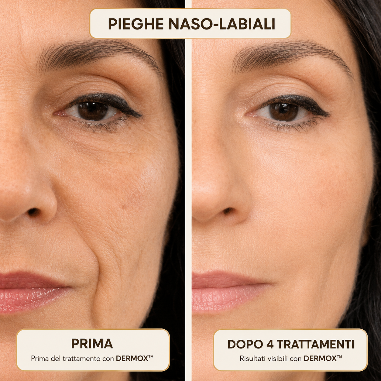 Dermox™ Sistema di Micro-infusione